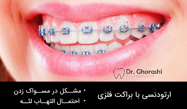 انواع ارتودنسی (براکت فلزی)