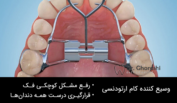 وسیع کننده کام یا پالاتال اکسپندر