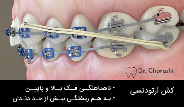 کش در ارتودنسی