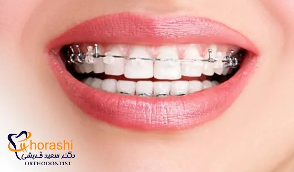 ارتودنسی دیمون شفاف
