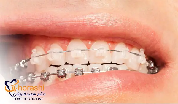 انواع ارتودنسی دیمون شفاف و فلزی