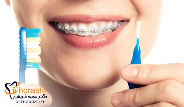 رعایت بهداشت دهان در درمان با ارتودنسی دیمون