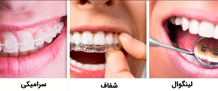 انواع ارتودنسی نامرئی