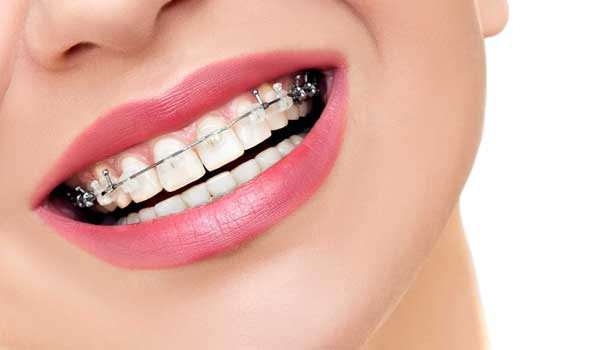 مراحل ارتودنسی به ترتیب برای فک بالا