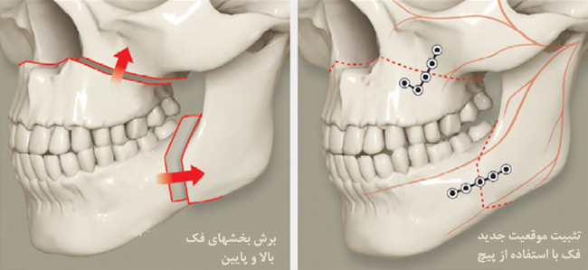 جراحی استئوتومی هر دو فک