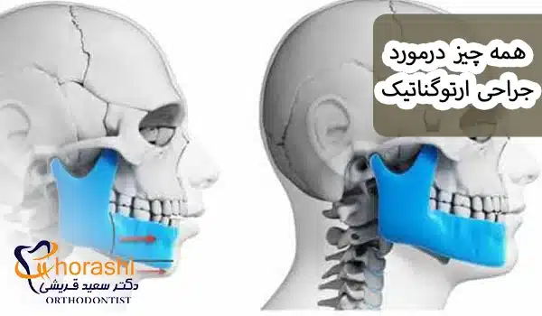 همه چیز درمورد جراحی ارتوگناتیک