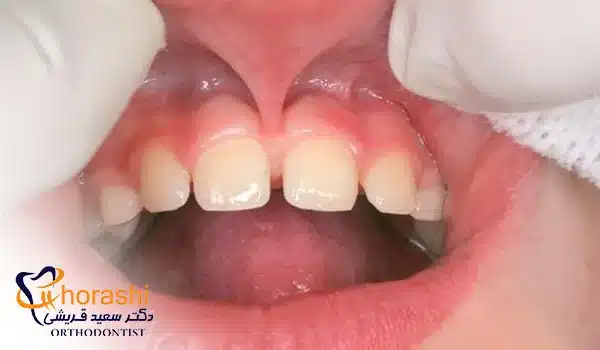 فرنوم لب بالا