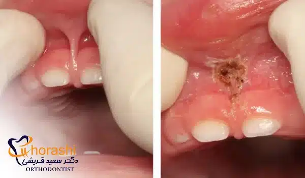 جراحی فرنکتومی لب