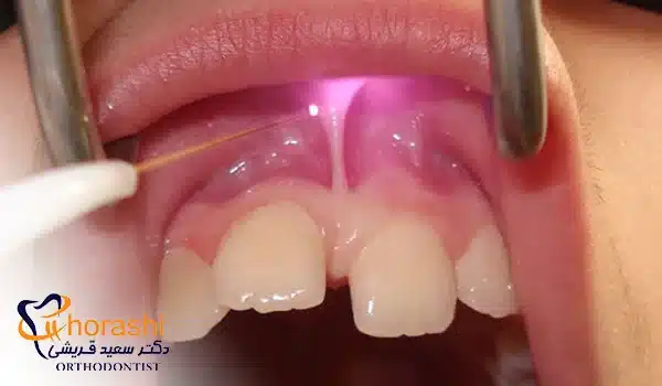 فرنکتومی با لیزر
