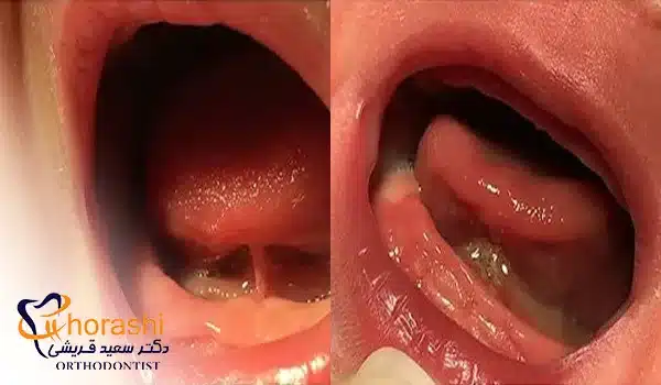 فرنکتومی زبان در نوزاد