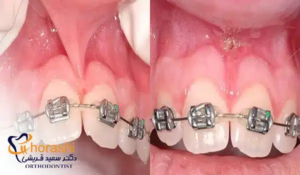 فرنکتومی در ارتودنسی