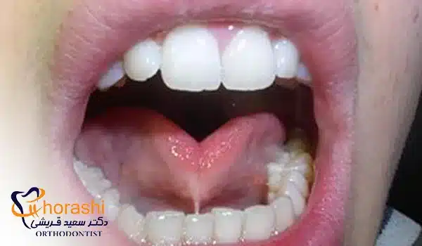 فرنوم زبان در بزرگسالان