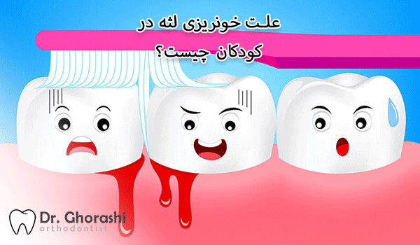 علت خونریزی لثه در کودکان چیست؟