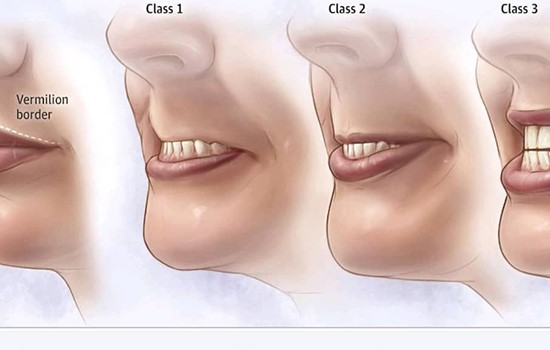 عارضه مال اکلوژن چیست؟