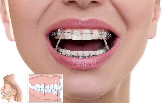 مال اکلوژن کلاس 1