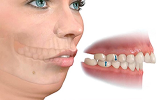 مال اکلوژن کلاس 2 (رتروگناتیسم)