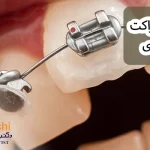 شکستن براکت ارتودنسی