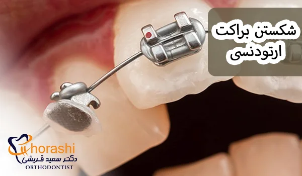 شکستن براکت ارتودنسی