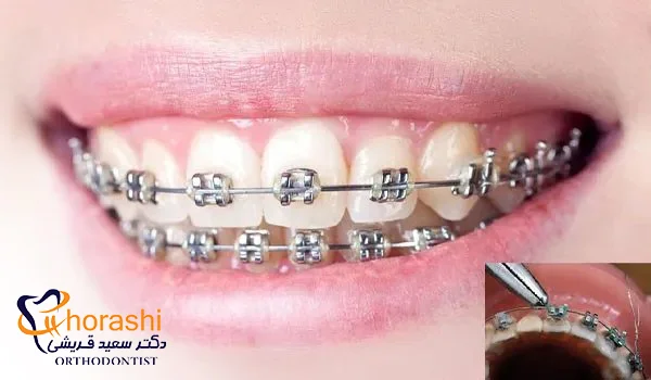 قبل و بعد تعمیر براکت شکسته ارتودنسی