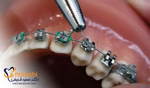 ترمیم براکت شکسته ارتودنسی