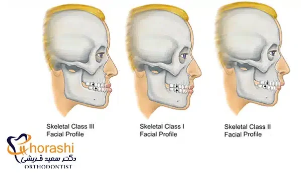 انواع نا همترازی فک ها 