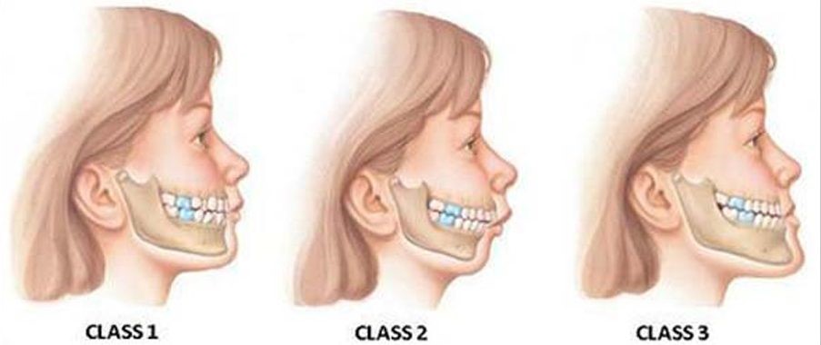 تشخیص و طبقه بندی انواع مال اکلوژن