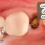 درمان عفونت جای دندان کشیده شده