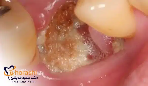 عکس عفونت دندان کشیده شده