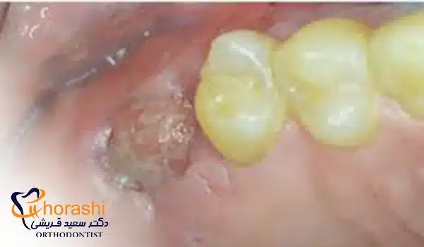 عکس عفونت لثه پس از کشیدن دندان
