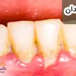 همه چیز در مورد پلاک دندان و رفع آن
