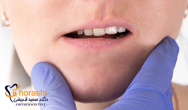 مال اکلوژن و صدای تق‌تق فک