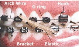 چهار بخش اصلی براکت ارتودنسی