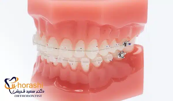 براکت دندان