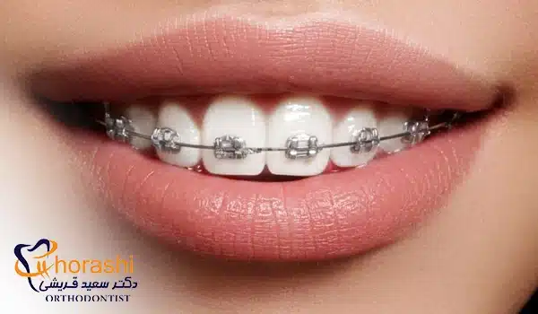 عکس براکت کروم کبالت روی فک بالا