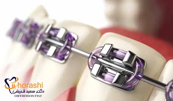 عکس براکت ارتودنسی