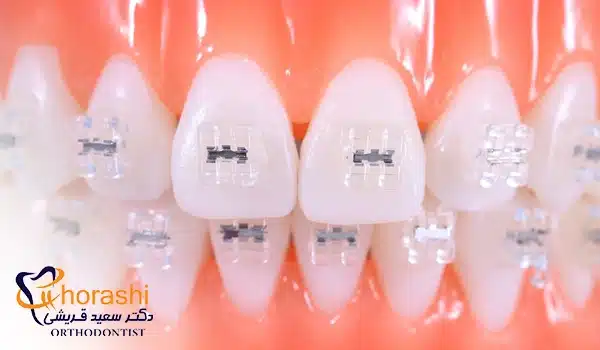 عکس براکت ارتودنسی رزین کامپوزیت