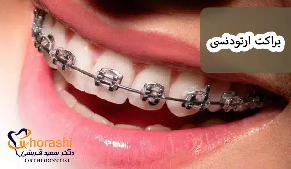 براکت ارتودنسی