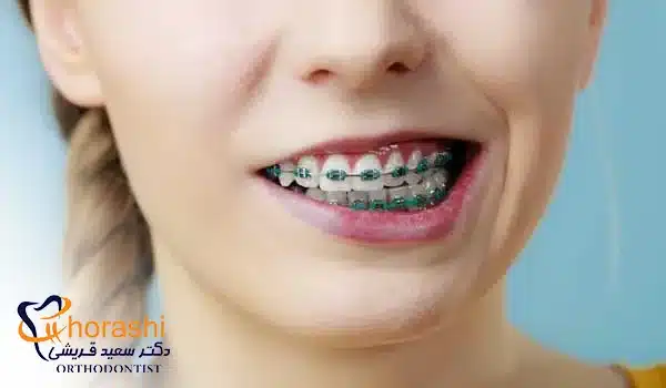 براکت ارتودنسی با کش رنگی