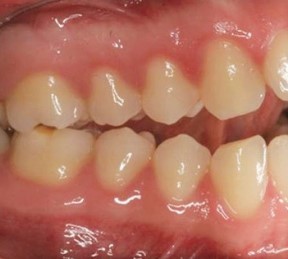 مال اکلوژن کلاس سه