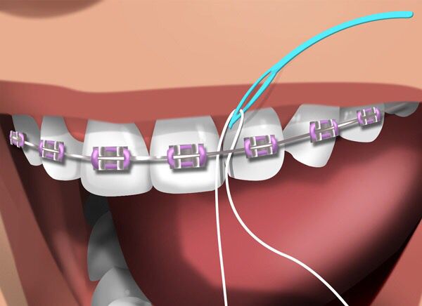 انواع نخ دندان مخصوص ارتودنسی