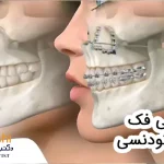 جراحی فک برای ارتودنسی