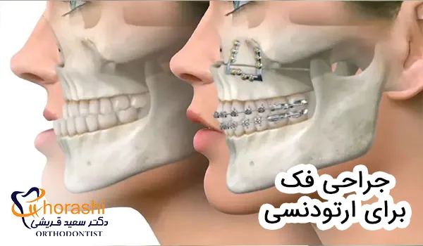 جراحی فک برای ارتودنسی