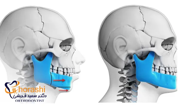 تغییرات فرم فک قبل و بعد از جراحی ارتودنسی