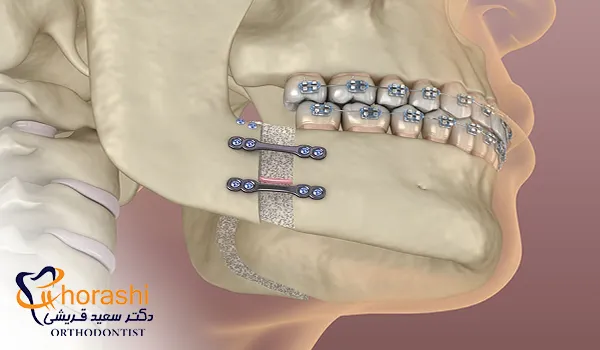 تاثیر جراحی فک برای ارتودنسی روی فرم فک پایین