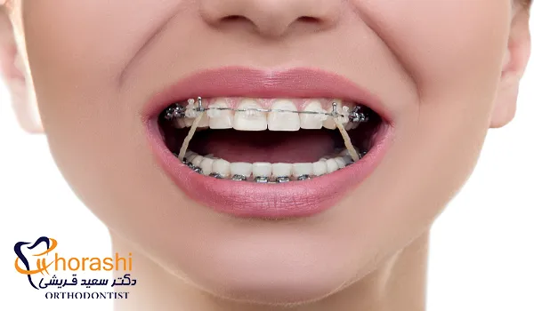 انجام ارتودنسی بدون نیاز به جراحی فک