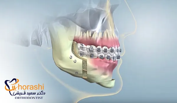 جراحی فک و چانه برای ارتودنسی