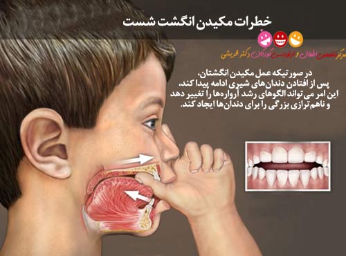 خطر مکیدن انگشت برای دندان