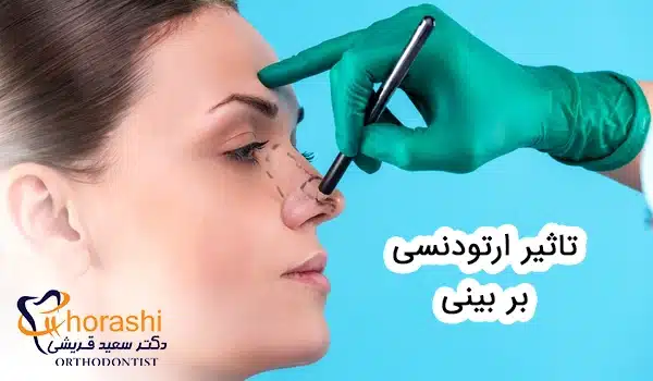 تاثیر ارتودنسی بر بینی