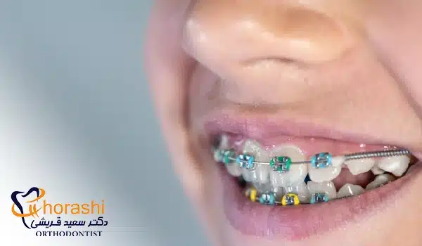 انجام ارتودنسی ثابت قبل از عمل بینی