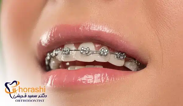 تاقیر ارتودنسی ثابت بر بینی